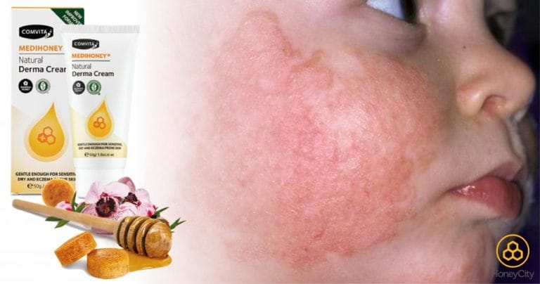Eczema Cure Manuka Honey Benefits: Healing naturally